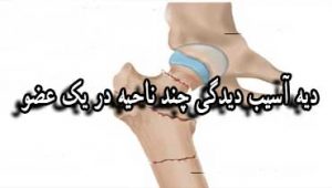دیه-آسیب-دیدگی-چند-ناحیه-در-یک-عضو